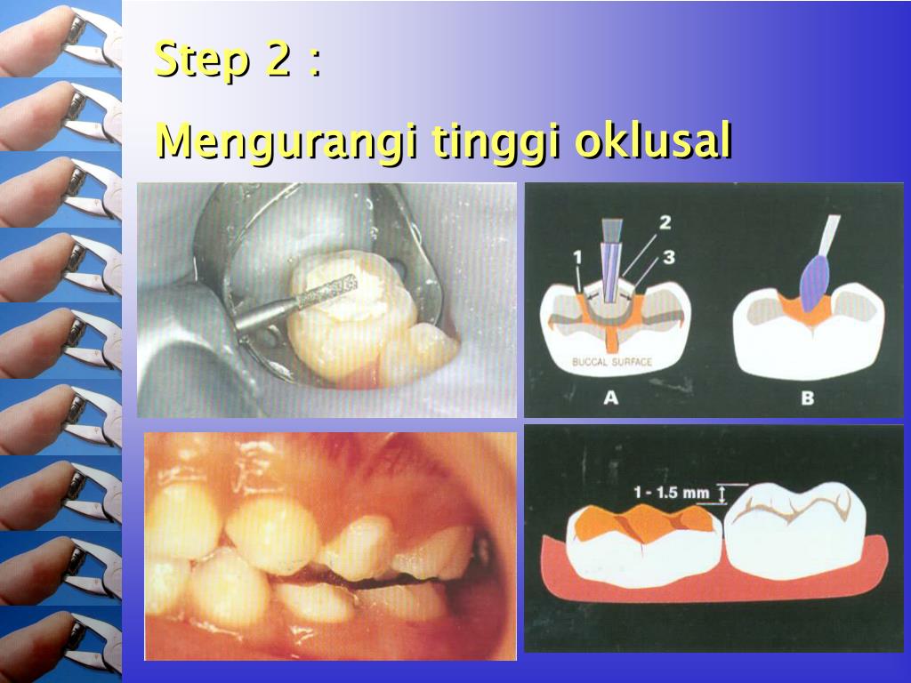 PPT Stainless Steel Crown PowerPoint Presentation, free download ID