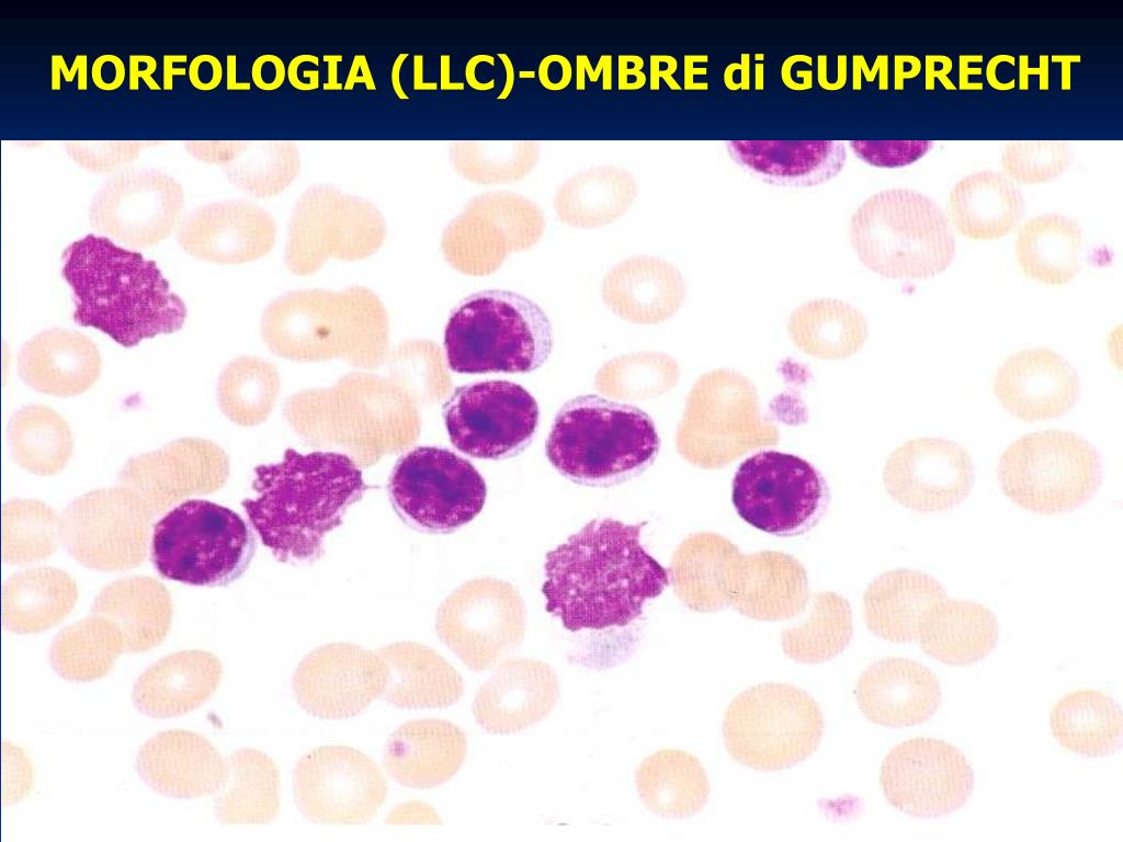 PPT - LEUCEMIA LINFATICA CRONICA PowerPoint Presentation, free download -  ID:3496144