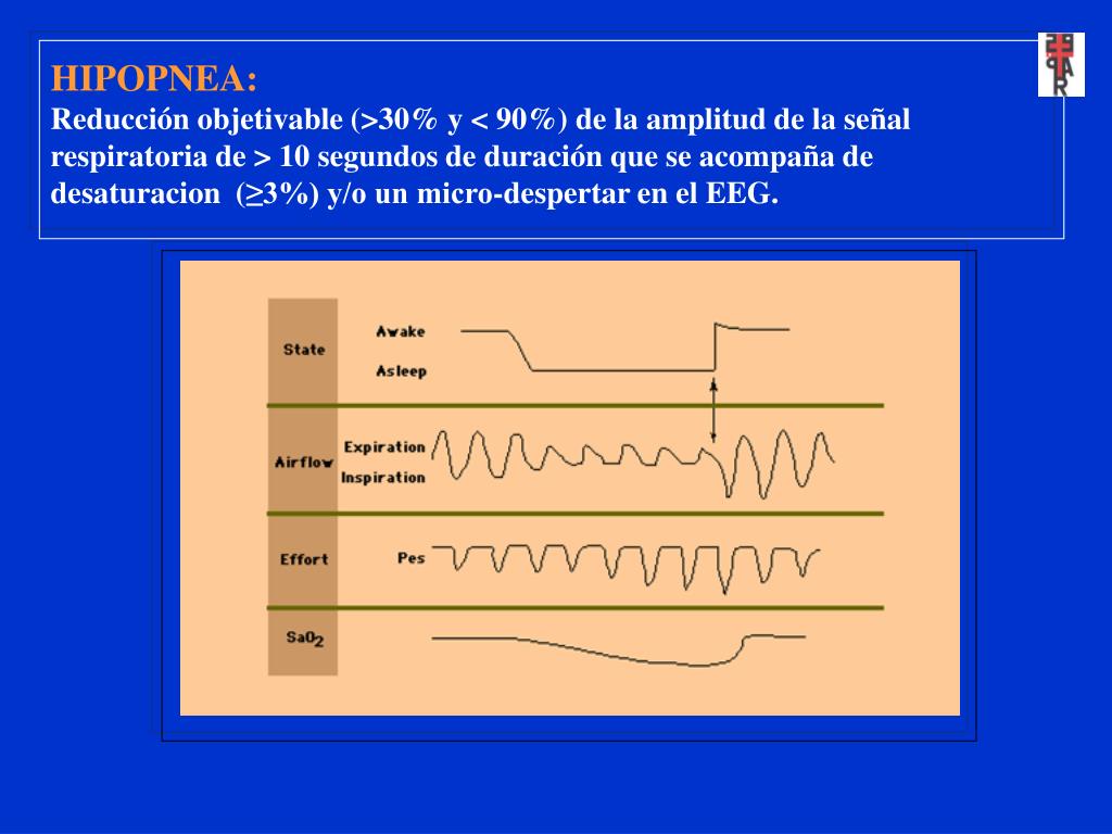 PPT Síndrome de ApneaHipoapnea del Sueño (SAHS) PowerPoint