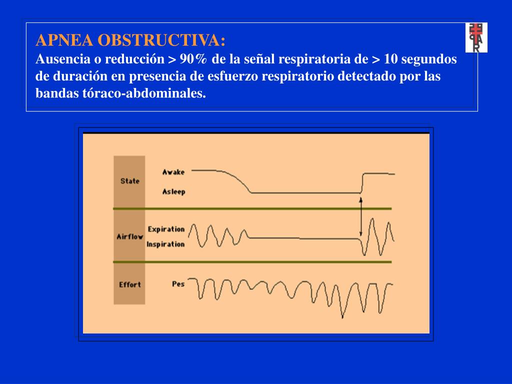 PPT Síndrome de ApneaHipoapnea del Sueño (SAHS) PowerPoint