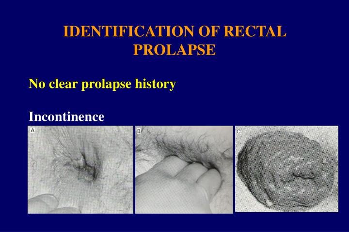 Ppt Rectal Prolapse Clinical Assessment Powerpoint Presentation Id