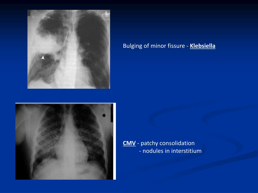PPT Alveolar / Airspace lung disease Acute,chronic and ground glass