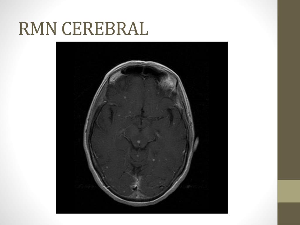 rmn cerebral rmn cerebral