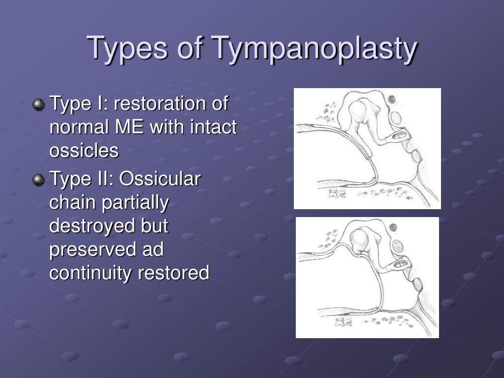 Types Of Tympanoplasty