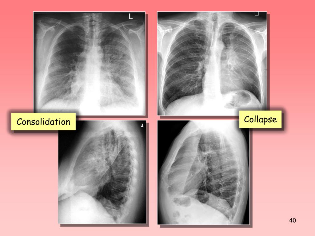PPT Principles Of Chest X Ray Interpretation PowerPoint Presentation PPT Principles Of Chest X Ray Interpretation PowerPoint Presentation