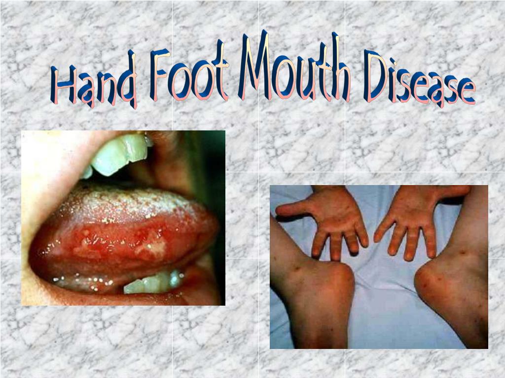 PPT Hand Foot Mouth Disease PowerPoint Presentation, free download