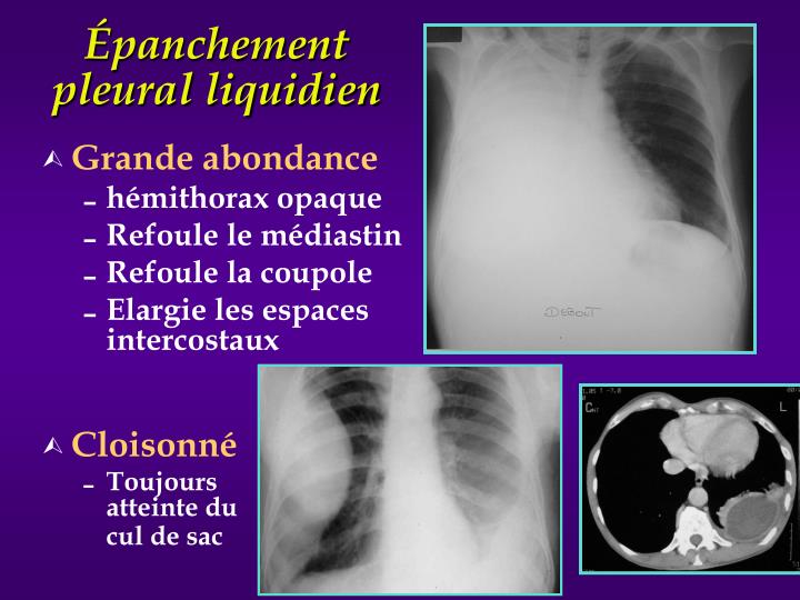 PPT Radiologie du thorax Sémiologie EIA Pneumologie PCEM2 Partie 1