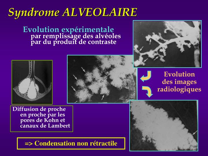 PPT - Radiologie du thorax Sémiologie EIA Pneumologie - PCEM2 Partie 1 ...