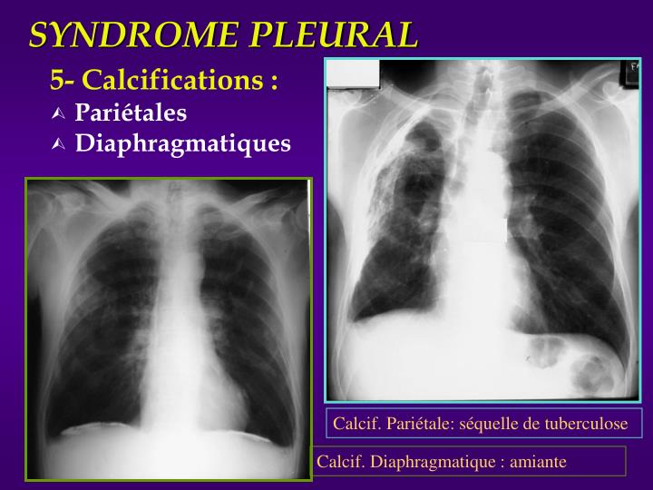 PPT - Radiologie du thorax Sémiologie EIA Pneumologie - PCEM2 Partie 1 ...
