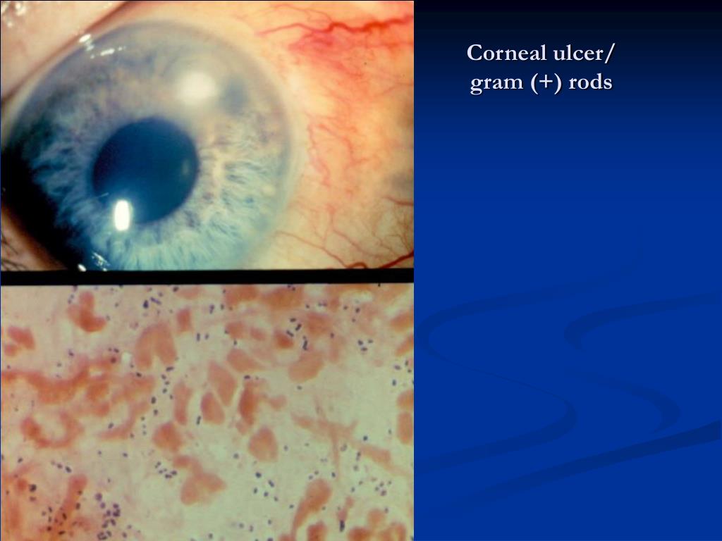 PPT Infectious Keratitis Differential Diagnosis & Clinical