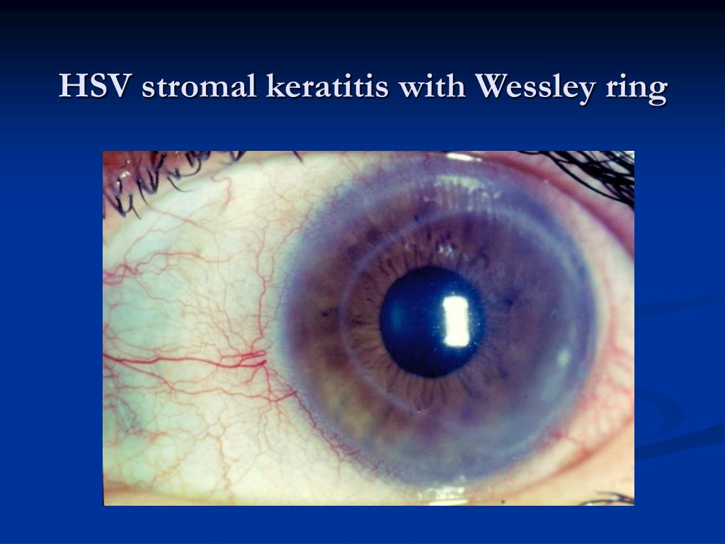PPT Infectious Keratitis Differential Diagnosis & Clinical