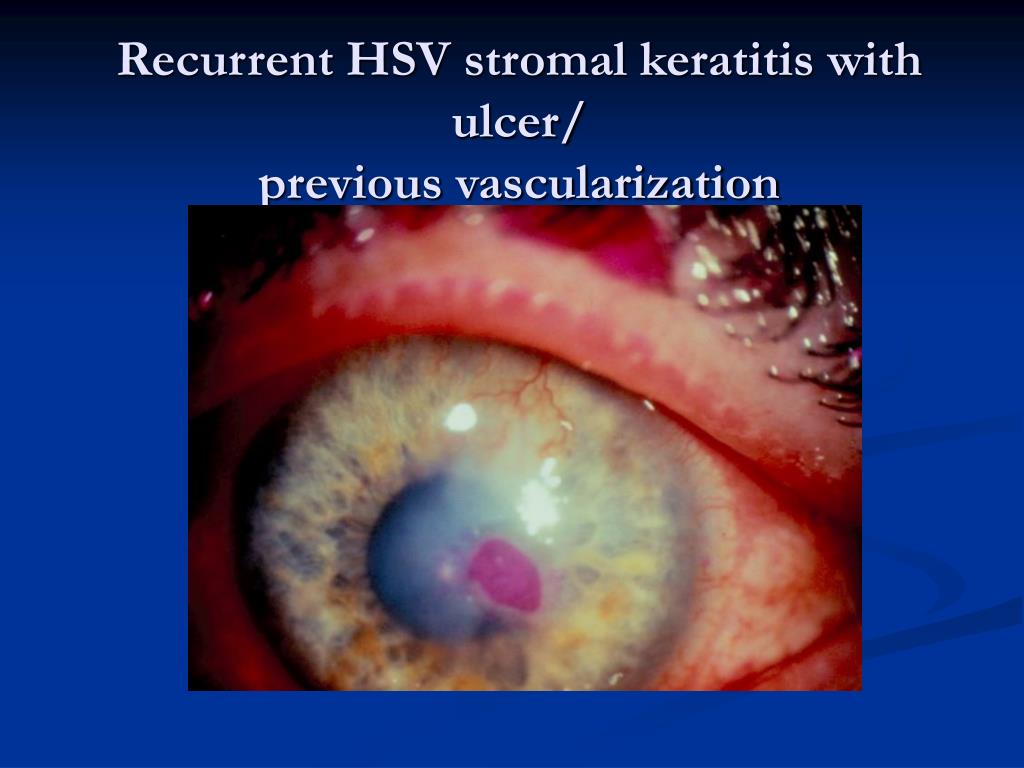 PPT Infectious Keratitis Differential Diagnosis & Clinical