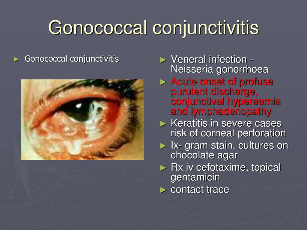 gonorrhea symptoms eyes