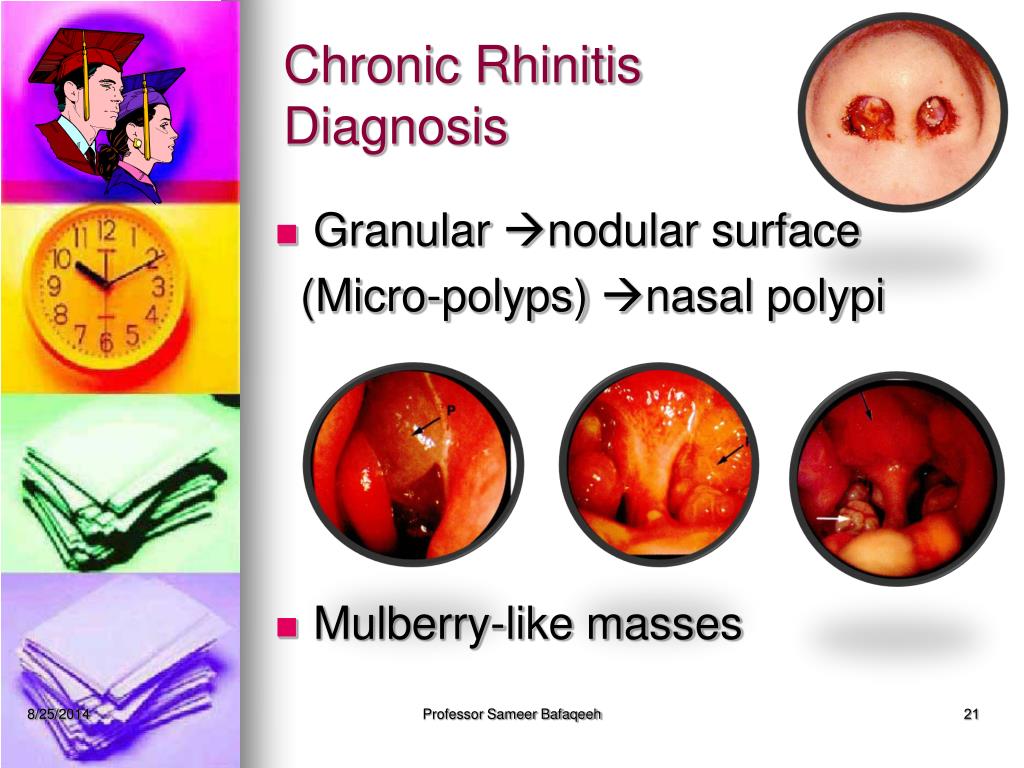 Ppt Non Allergic Rhinitis Powerpoint Presentation Free Download Id