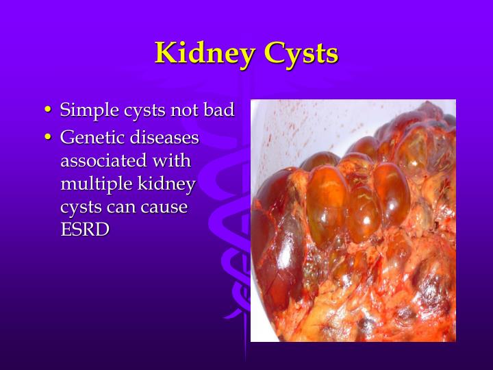 PPT Chronic Kidney Disease What You Need to Know PowerPoint