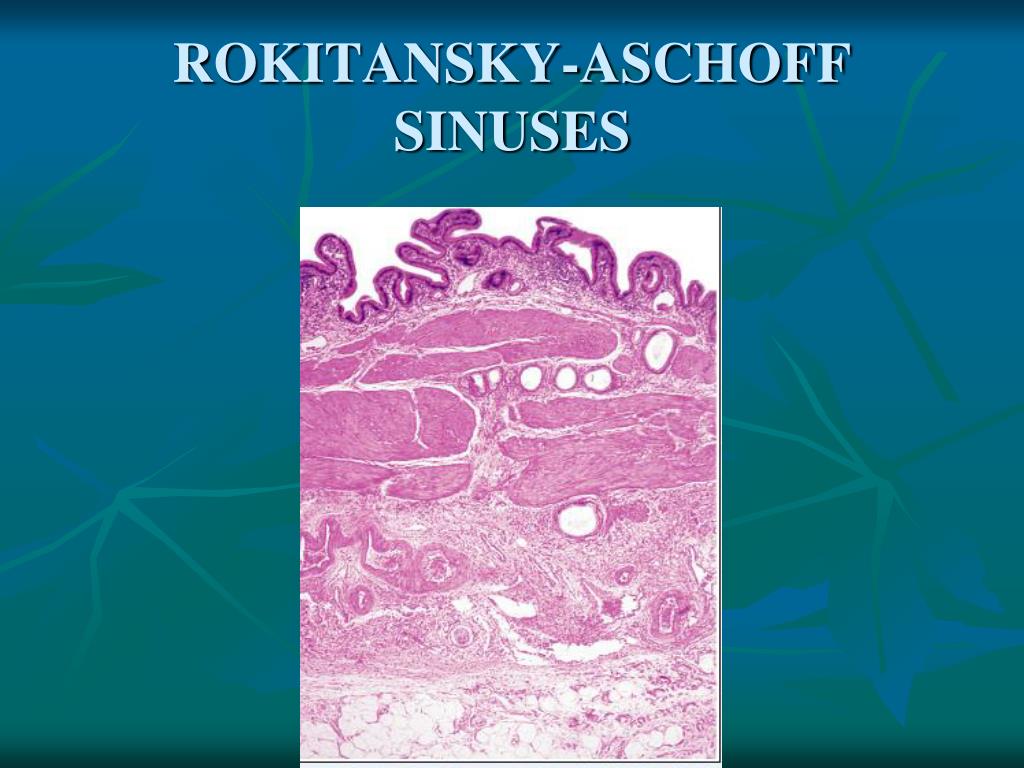 Sinus De Rokitansky Aschoff Rokitansky Aschoff Sinuses TVHG