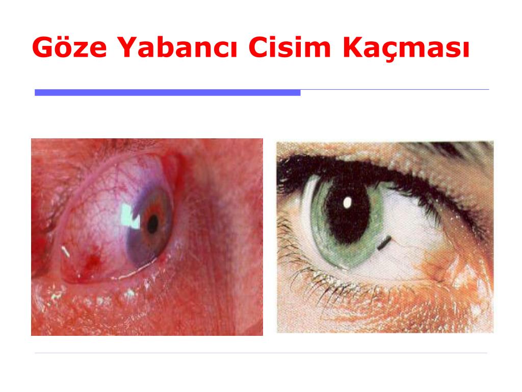 Ppt 11 Goz Kulak Ve Buruna Yabanci Cisim Kacmasinda Ilkyardim Powerpoint Presentation Id 3589352